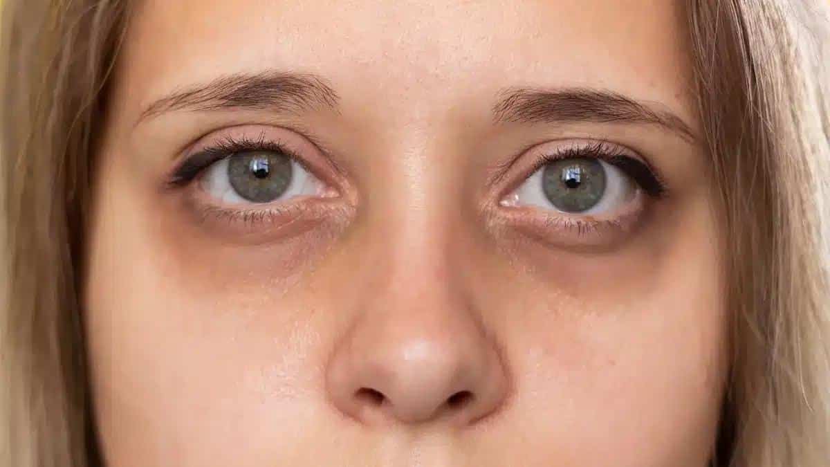 Bimatoprost Side Effects: What You Need to Know