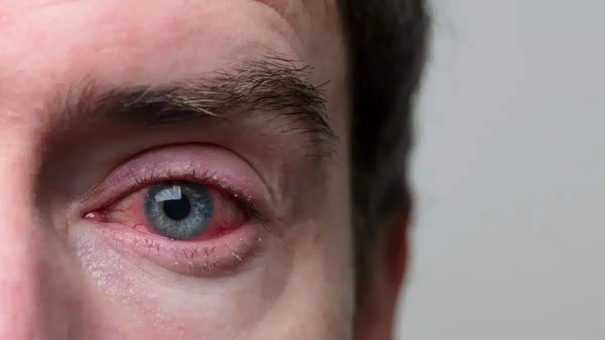 Understanding Dry Eye Allergy: Causes, Symptoms, and Treatment
