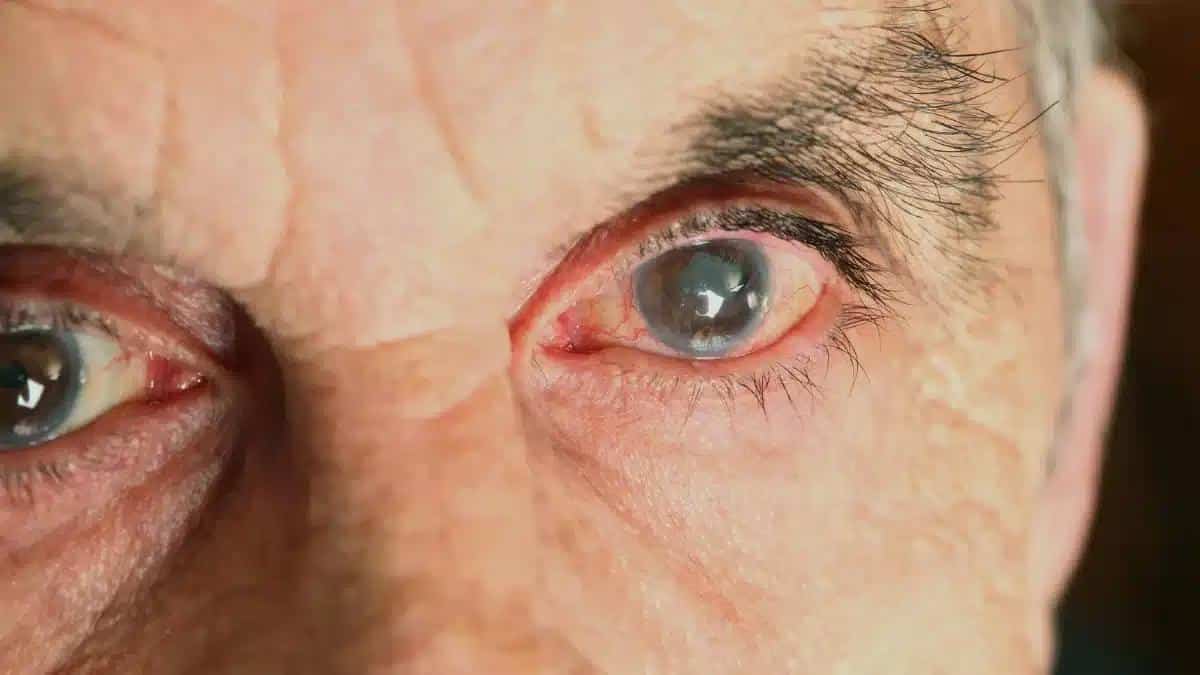 Open vs Closed Angle Glaucoma: An In-depth Comparison