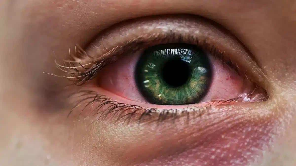 Understanding and Managing Eye Infection: A Comprehensive Guide