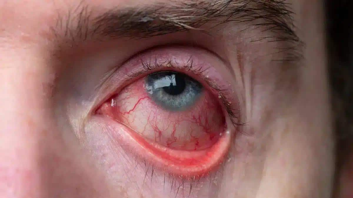 Iritis vs Uveitis: Understanding the Key Differences