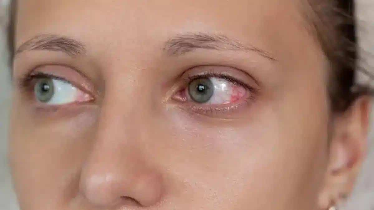 A Complete Guide on Uveitis: Symptoms, Causes, and Treatment