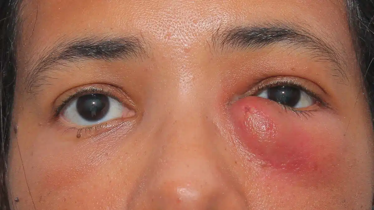blocked tear duct vs pink eye