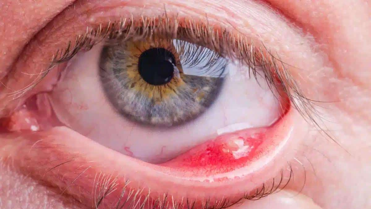 Exploring Eye Infection Causes and Ways to Prevent Them