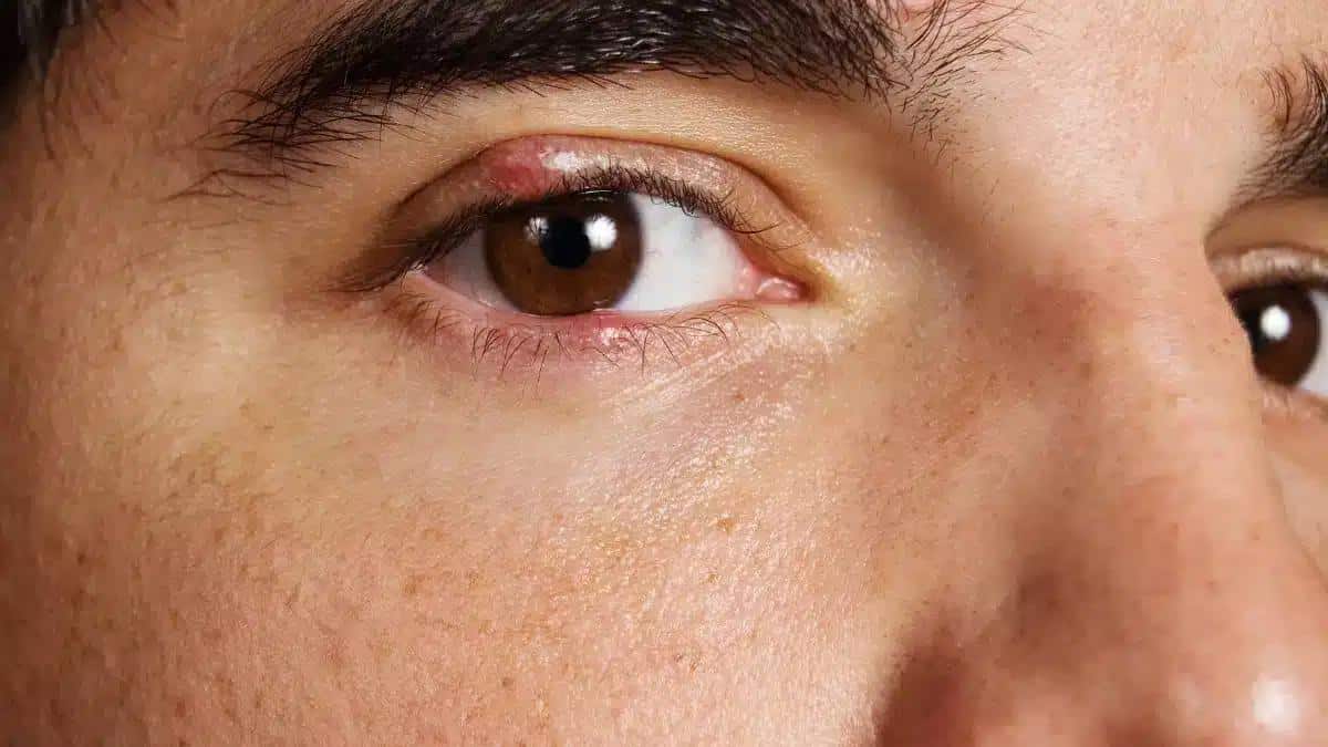7 Effective Home Remedies for Eye Infection