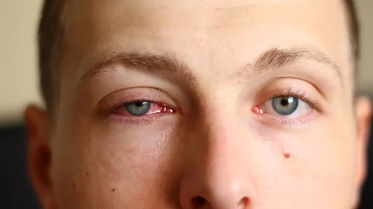 how does pink eye spread
