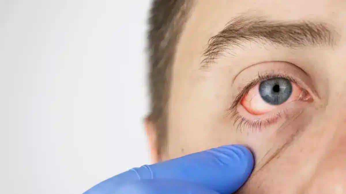 How Long Does Pink Eye Last: From Onset to Recovery