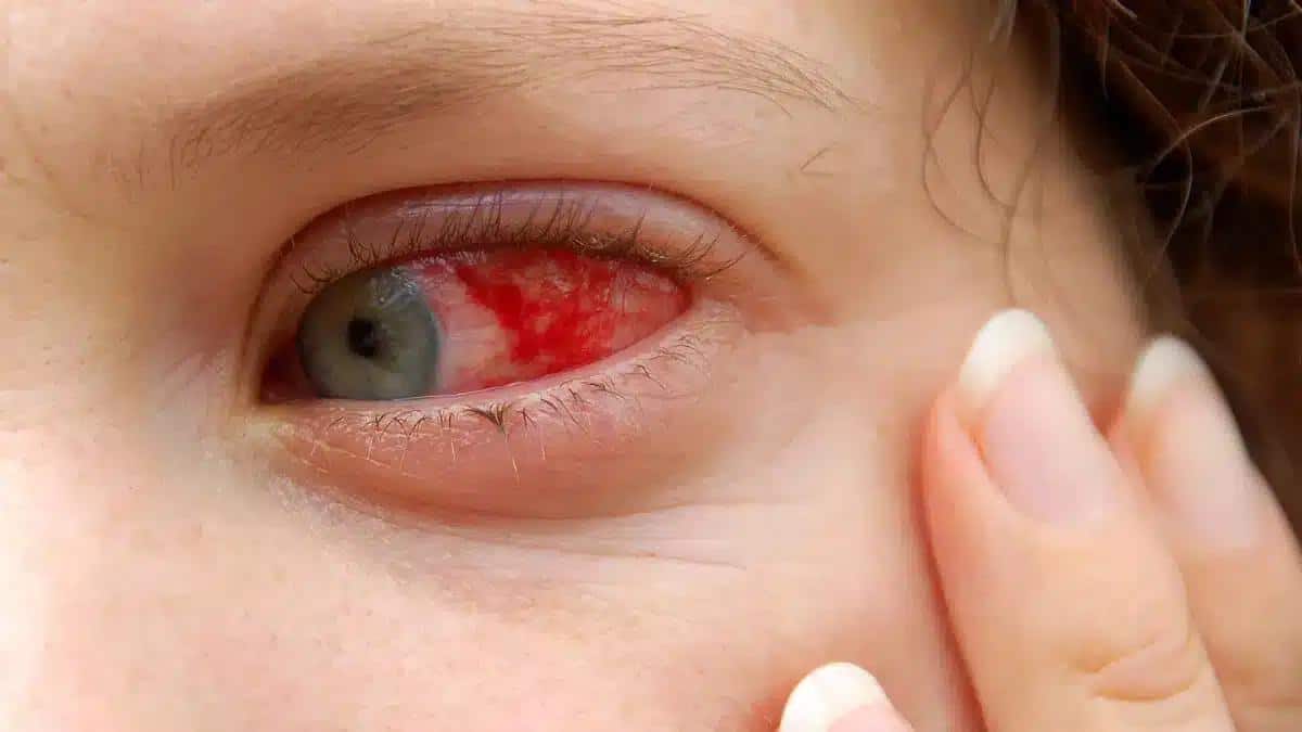 How Long is Pink Eye Contagious and How to Prevent Spreading It?