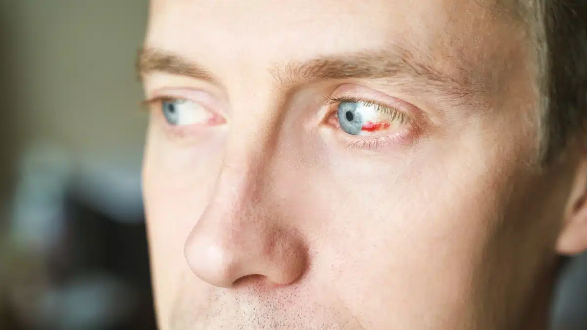 keratitis vs conjunctivitis