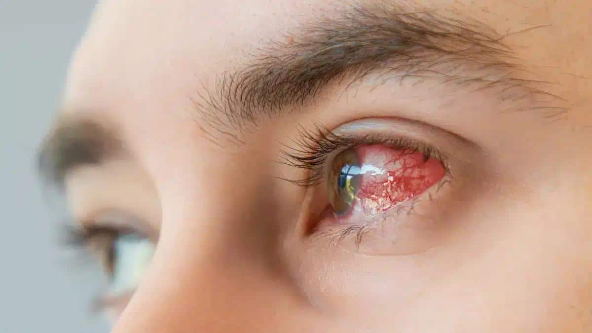 Keratitis vs Uveitis: Clearing the Confusion