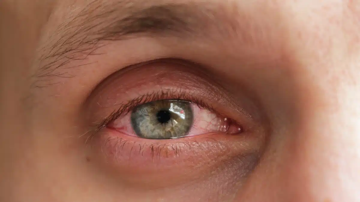 pink eye causes