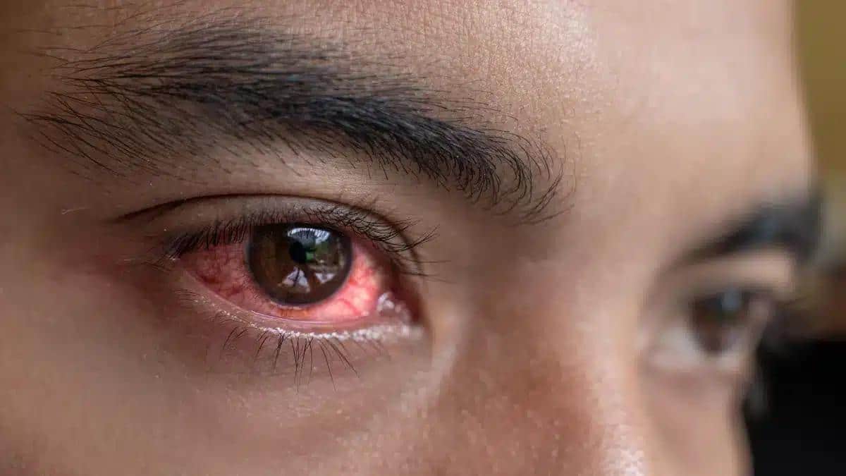 Is Pink Eye Contagious? How to prevent the infection?