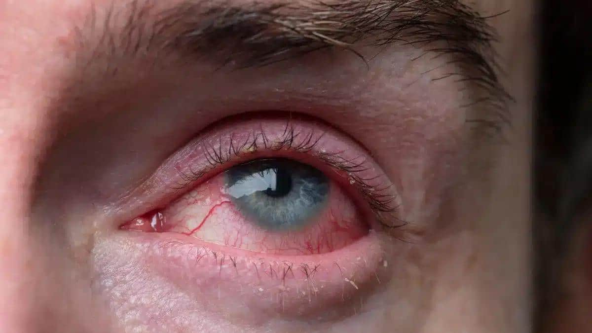 Is Pink Eye Dangerous? The Truth Revealed