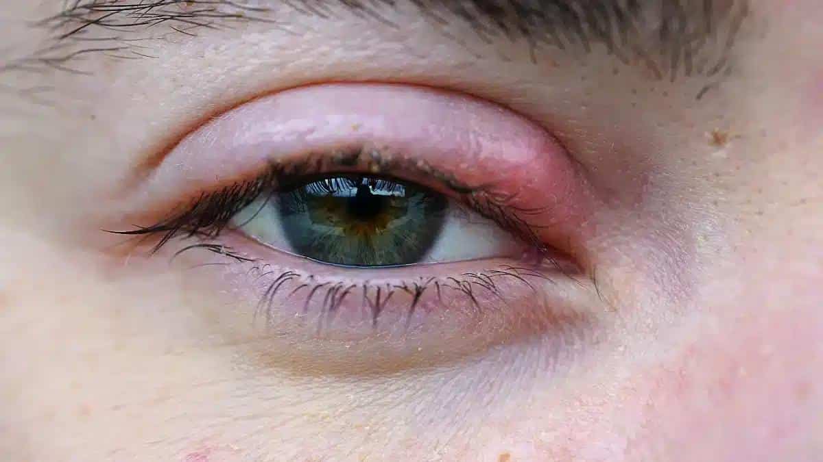 Pink Eye vs Stye: Understanding Causes, Symptoms, and Treatment