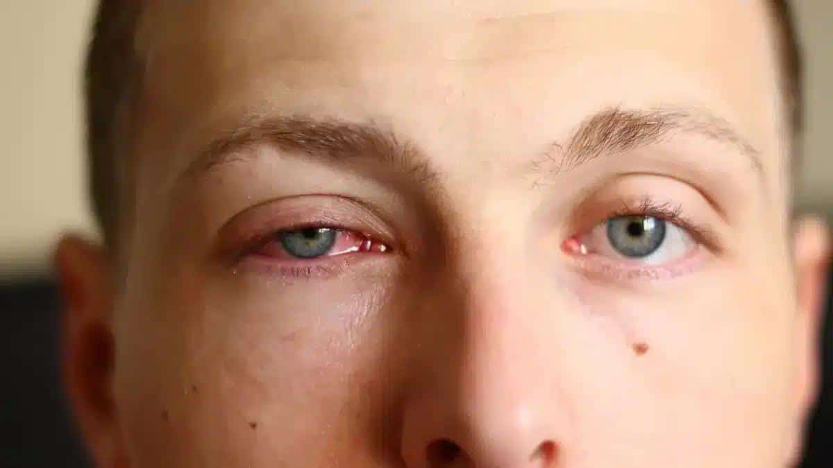 Pink Eye (Conjunctivitis): Causes, Symptoms, and Treatment