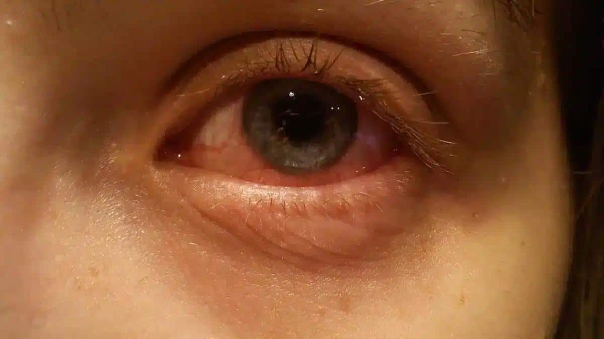 A Closer Look at Quick and Effective Bacterial Pink Eye Treatment