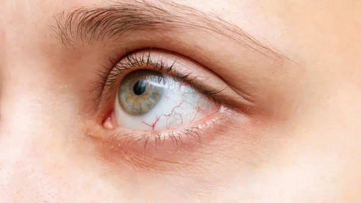 Uveitis Treatment: What You Need to Know
