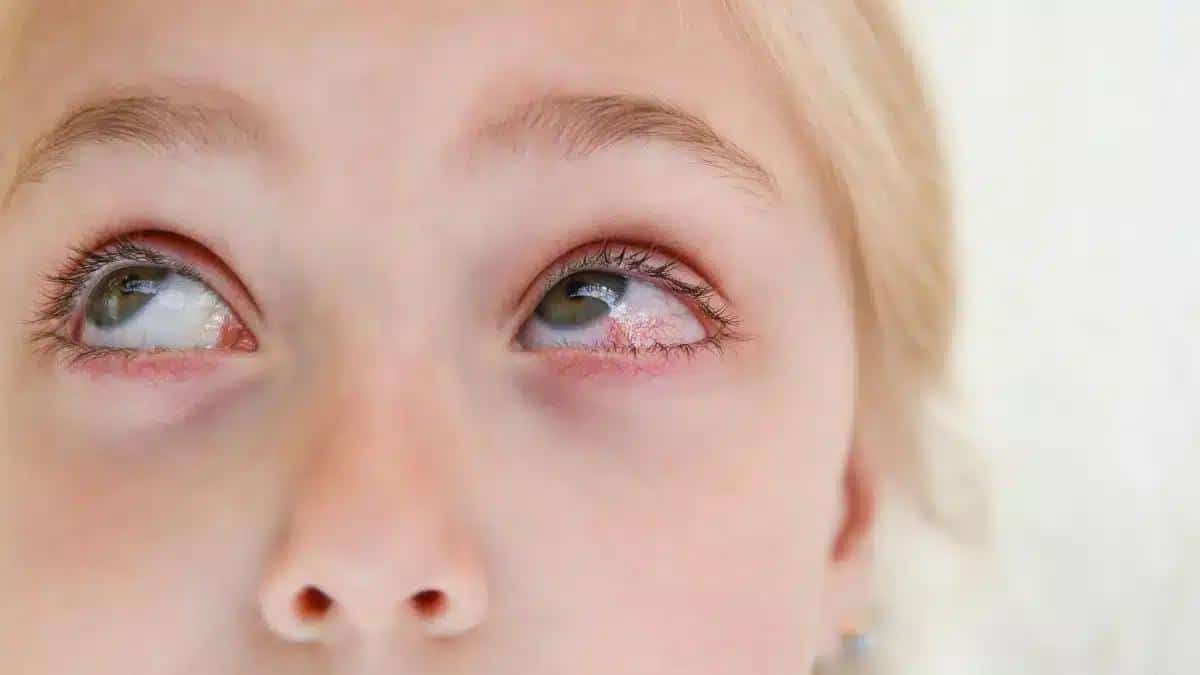 Viral Pink Eye Remedy Tips: From Natural to OTC Solutions