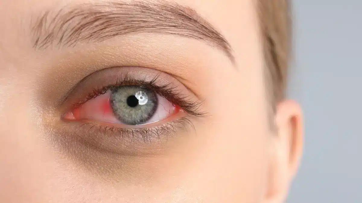 Viral vs Bacterial Pink Eye: Causes, Symptoms, and Treatment