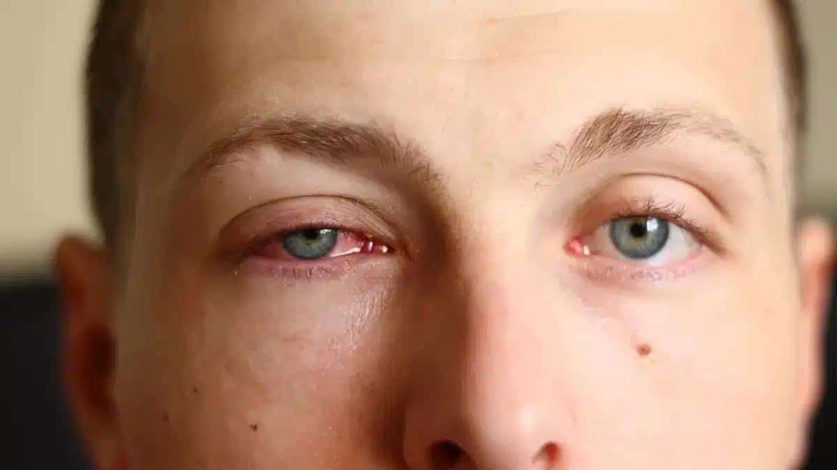 When is Pink Eye Not Contagious: Clearing up the Confusion