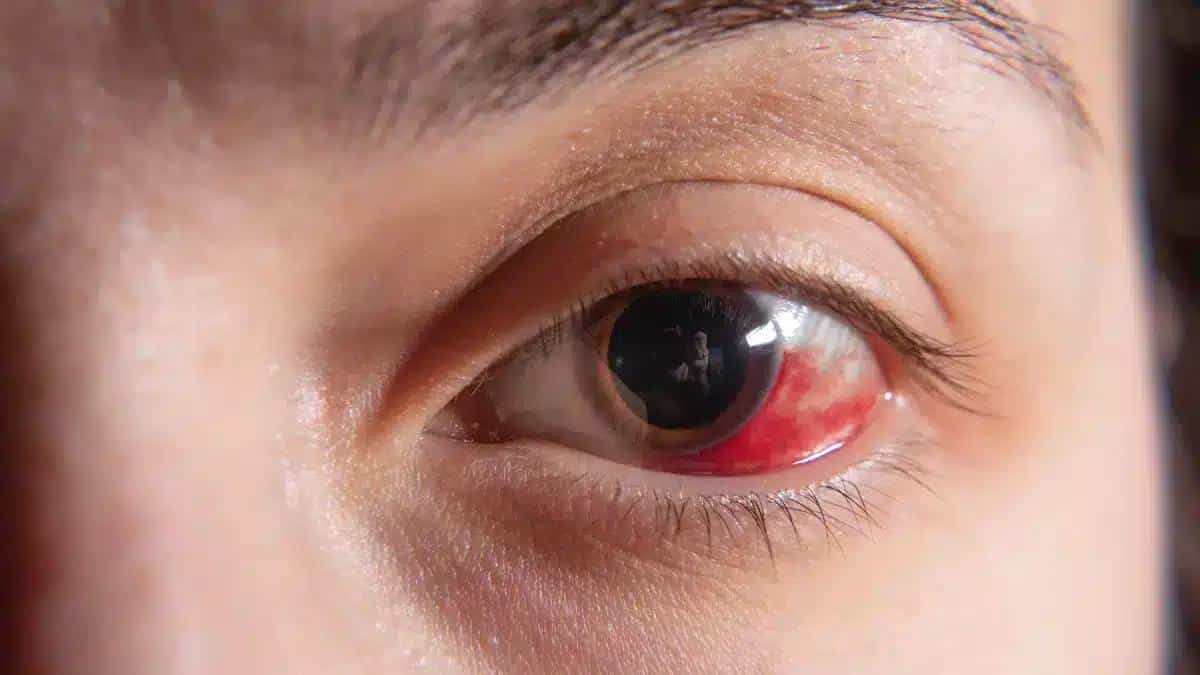 Understanding Exposure Keratitis: Symptoms, Causes, and Effective Prevention