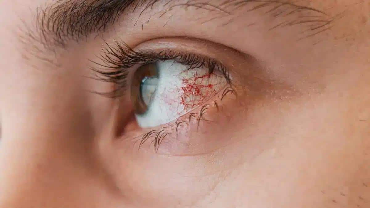 Keratitis vs Corneal Ulcer: What differentiates the two?