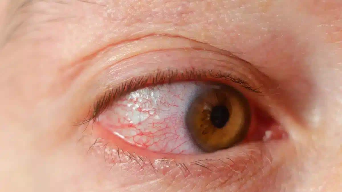 Bacterial Keratitis: Causes, Symptoms, and Treatment Options
