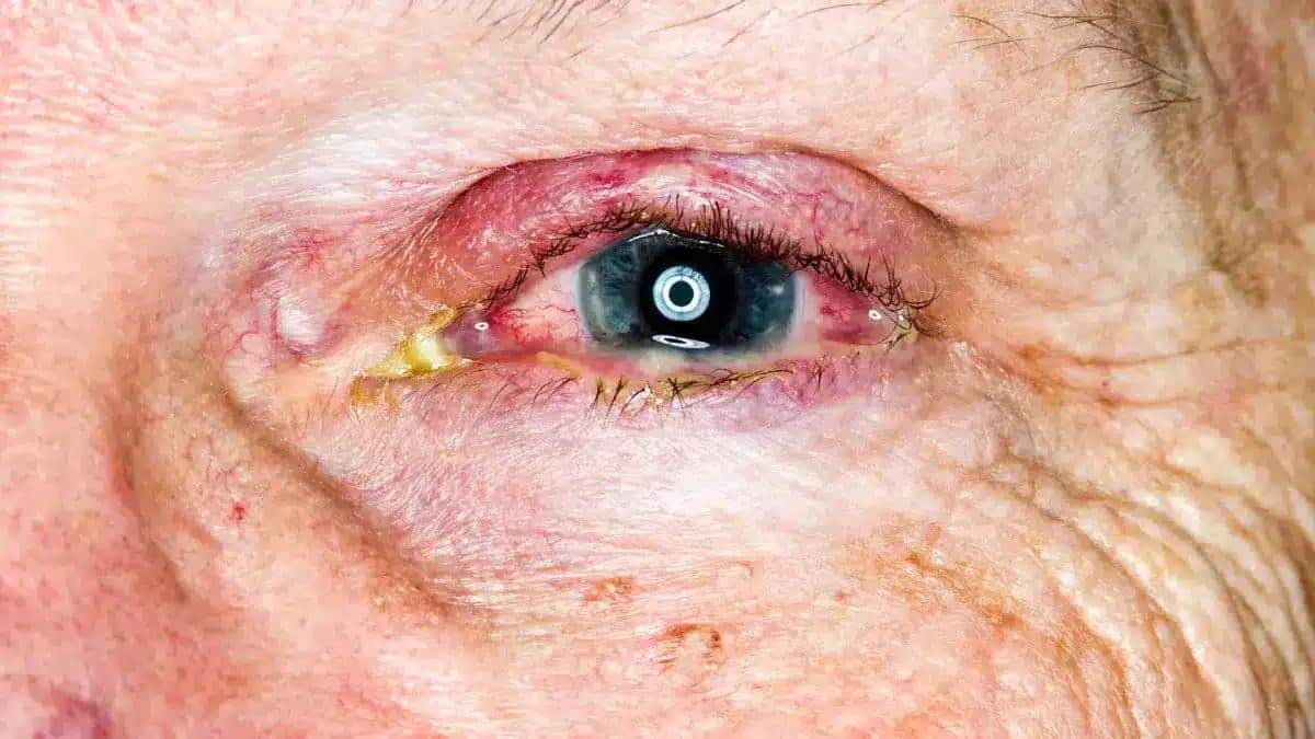 Unraveling Filamentary Keratitis: Causes, Symptoms, and Treatments 