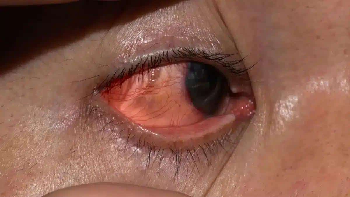 Navigating Herpes Keratitis: Symptoms, Causes, and Treatment Insights 