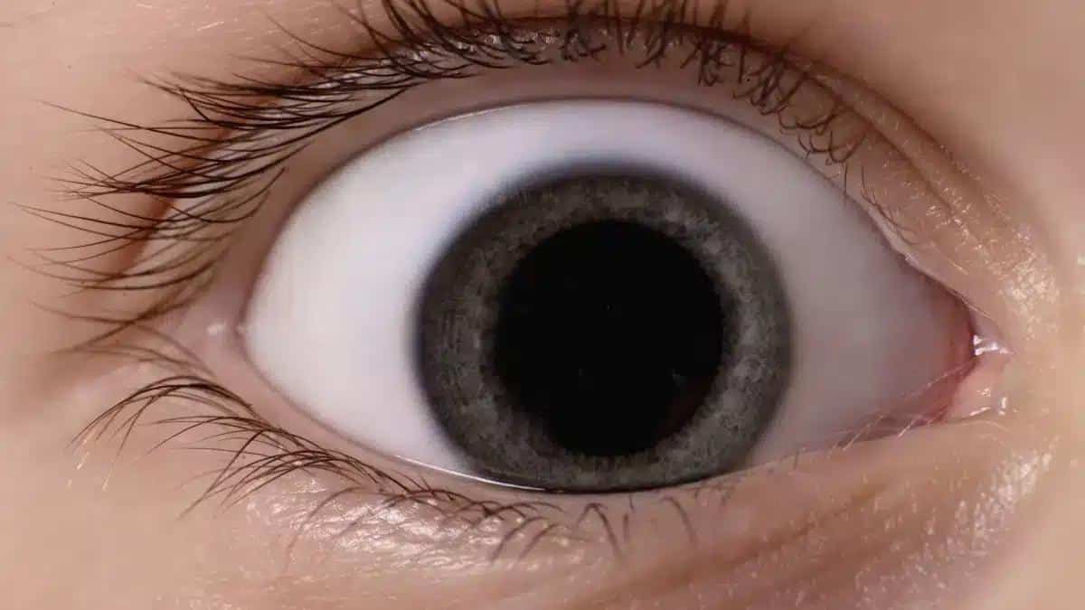 What is Interstitial Keratitis? Causes, Symptoms, Diagnosis, and Treatment 