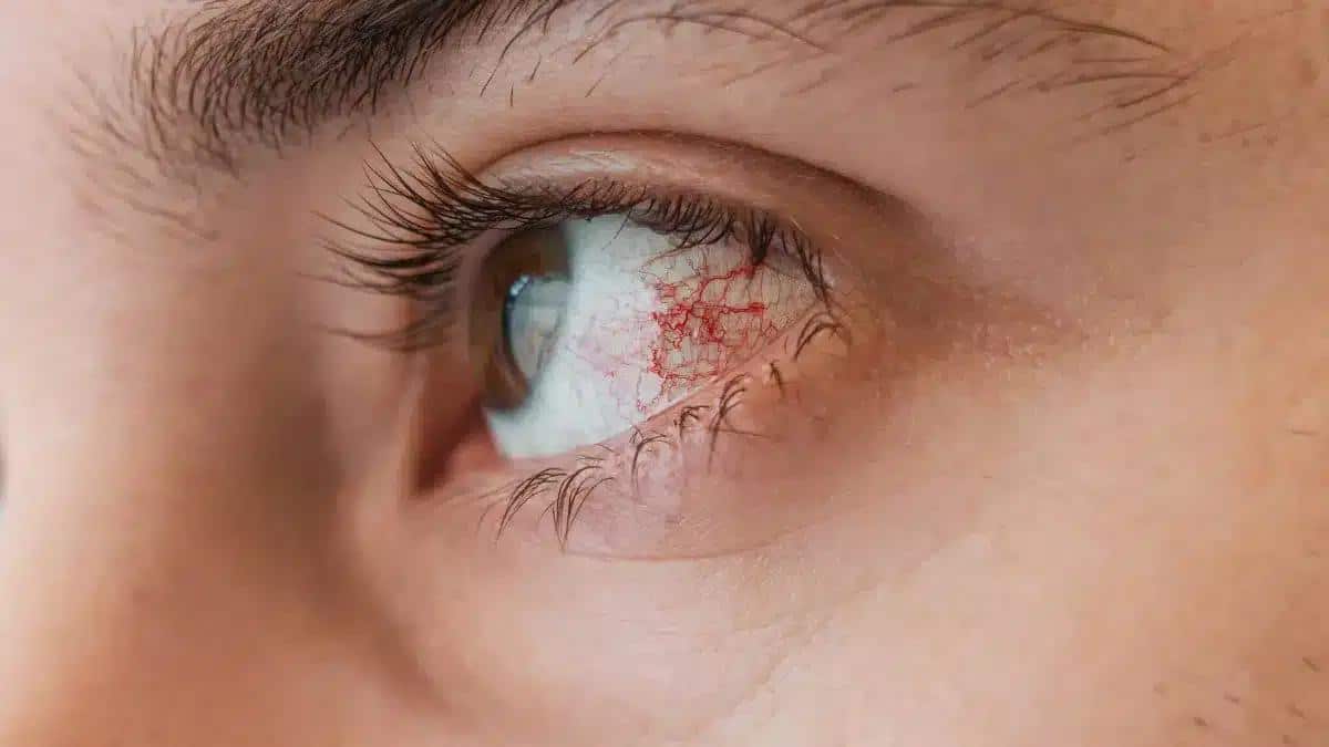 Keratitis Symptoms: Understanding the Signs of Corneal Inflammation