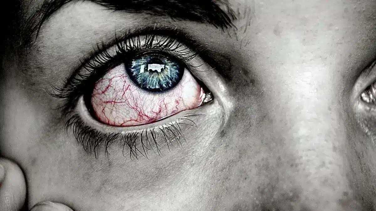 Neurotrophic Keratitis: Symptoms, Causes, and Treatment Options 