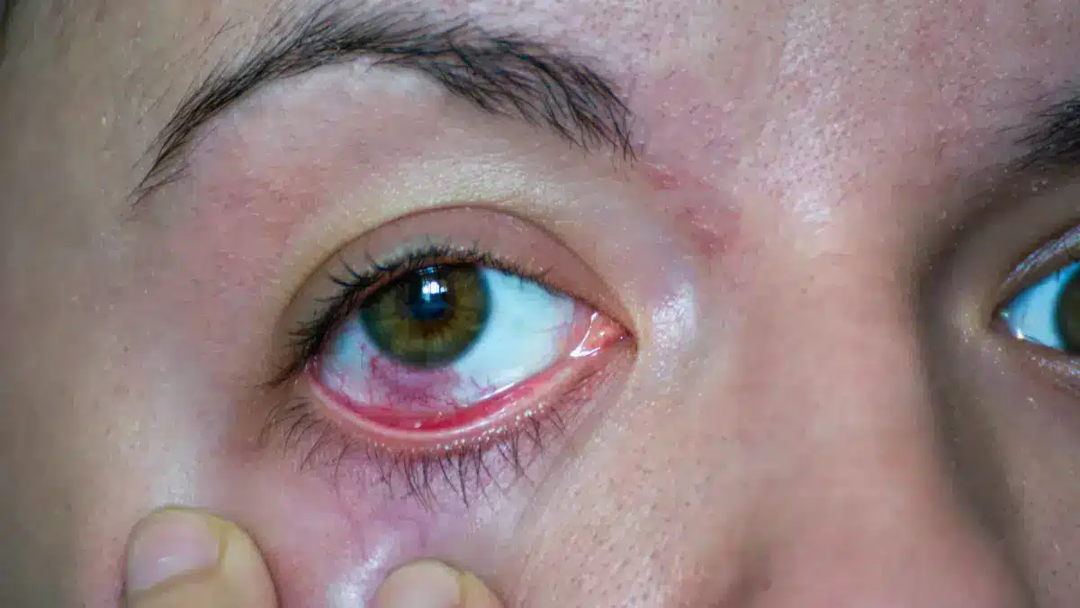 Pink-Eye-vs-Red-Eye