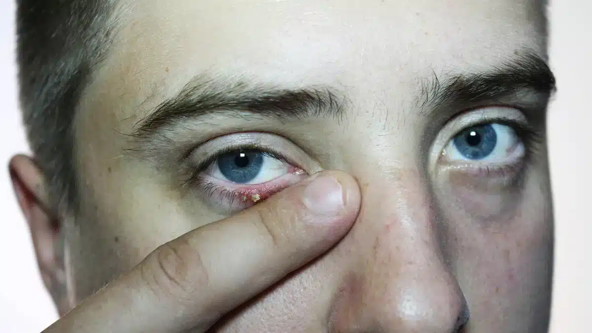 discharge-from-eye-allergies