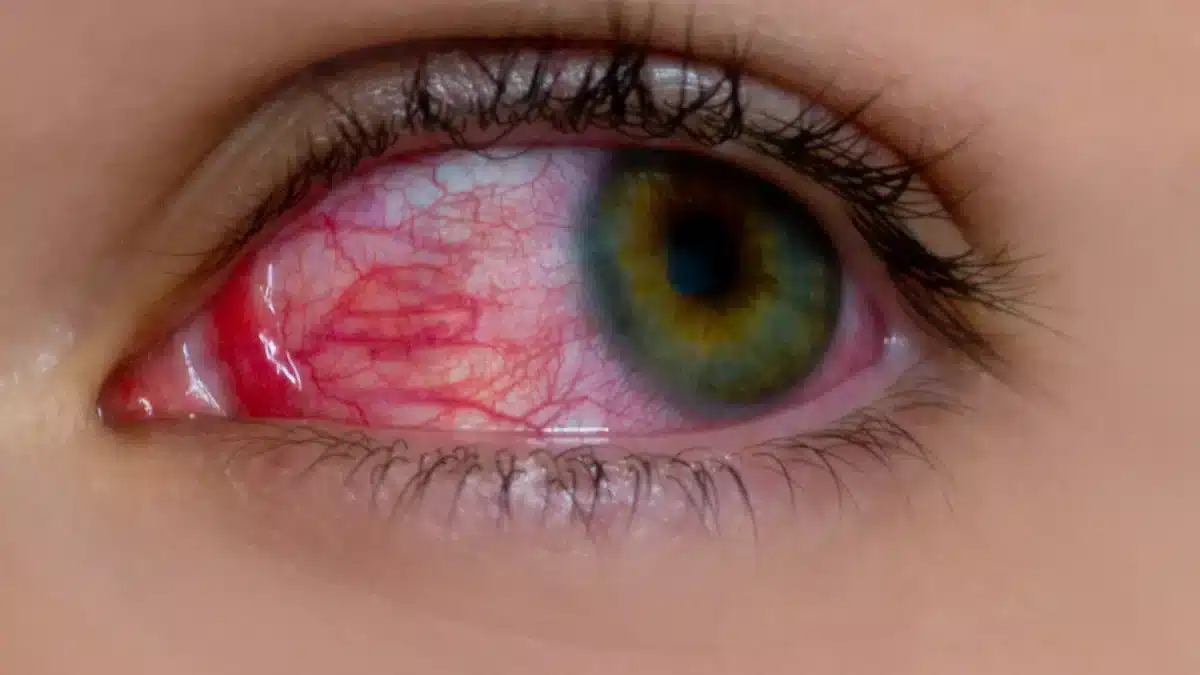 eye-allergy-treatment