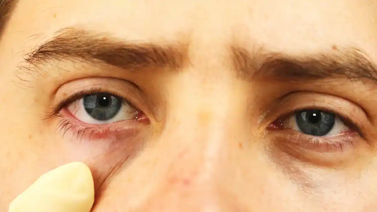 home-remedies-for-red-eyes