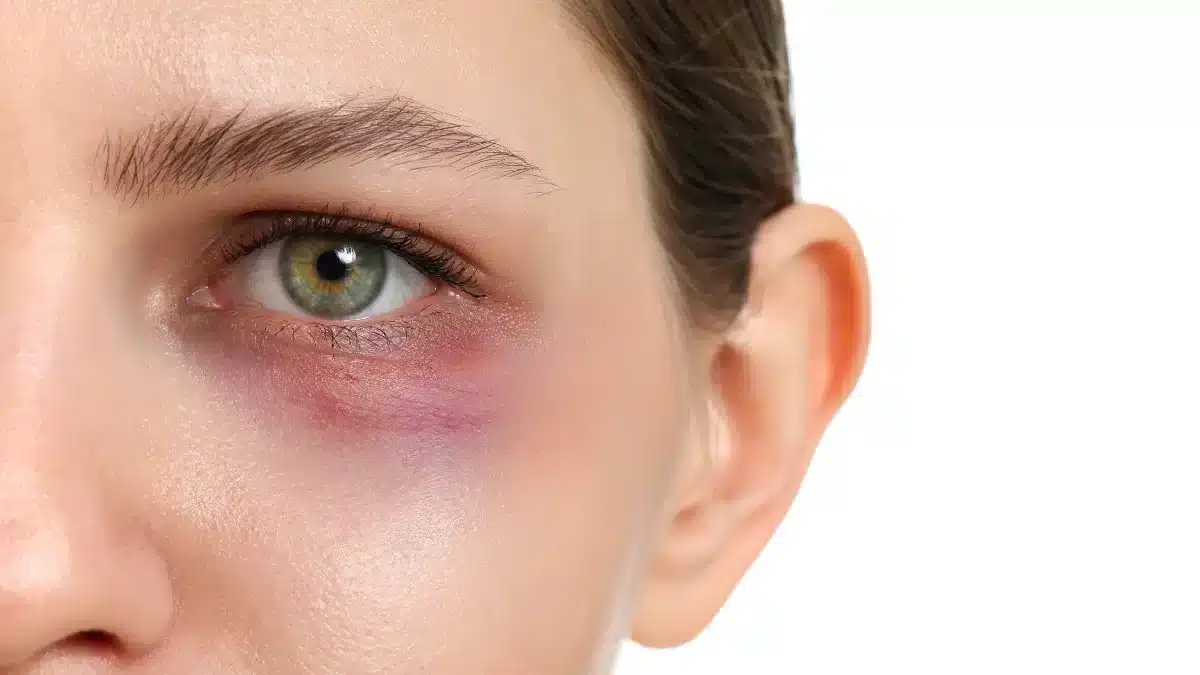 red-bumps-under-the-eyes