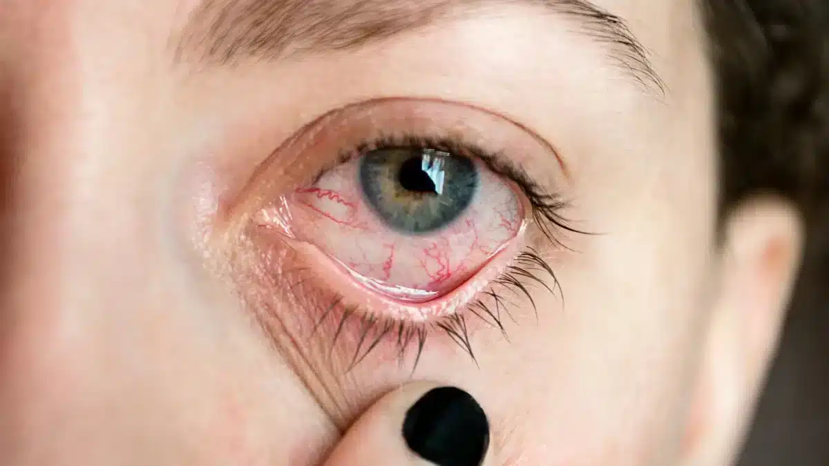 red-itchy-eyes
