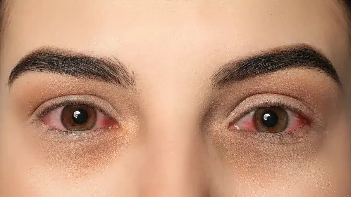 red_eyes_without_eye_drops