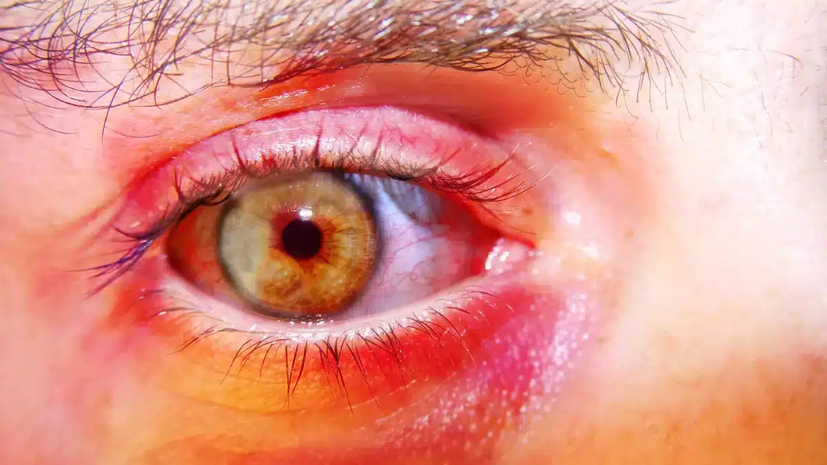 redness-around-the-eyes