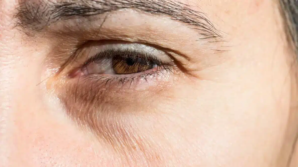 what-causes-bags-under-eyes