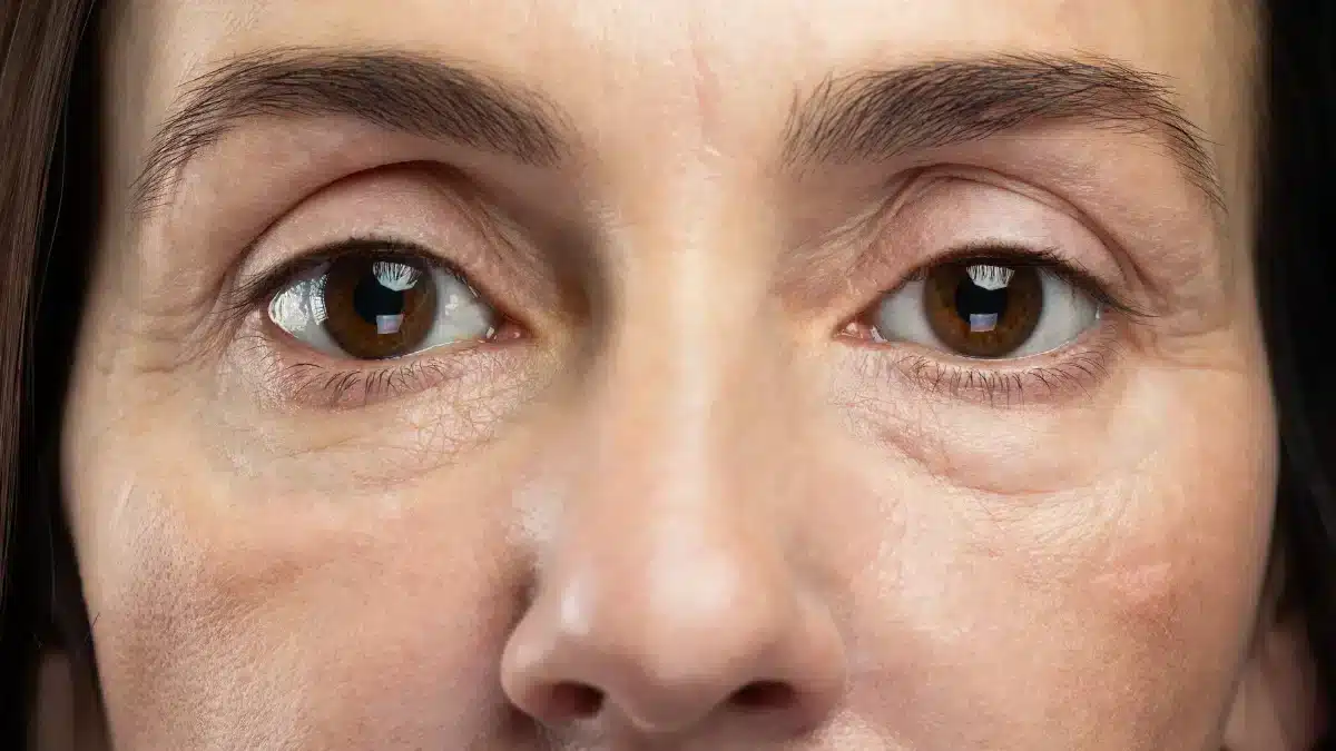 what-causes-puffy-eyes