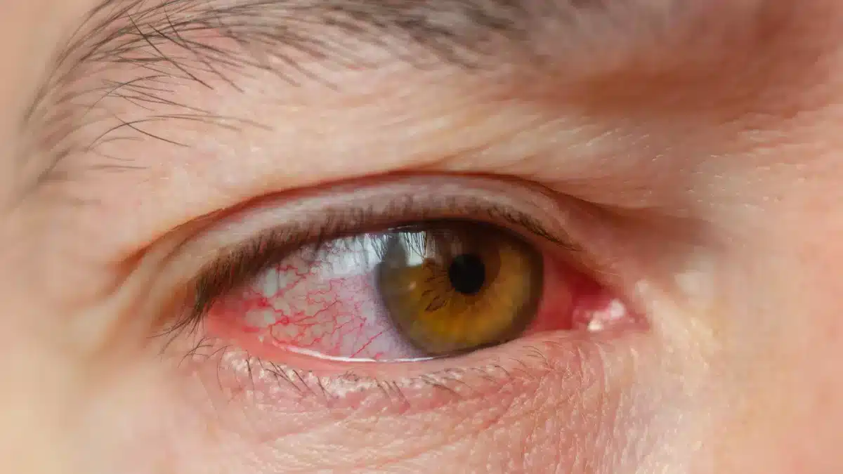 why-are-my-eyes-red