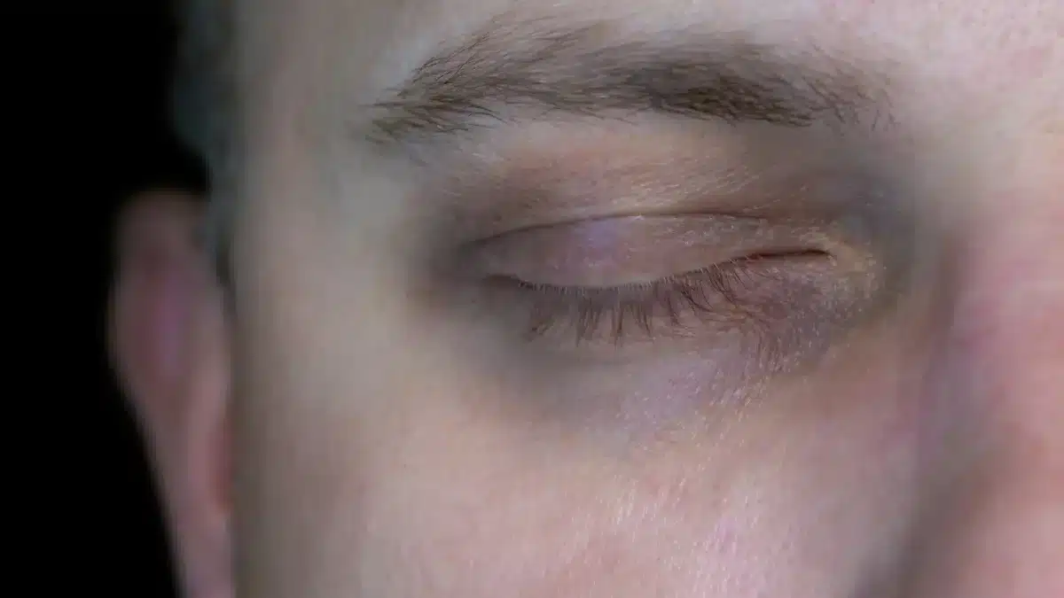 bags under eyes