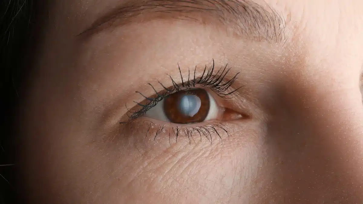 types of cataracts