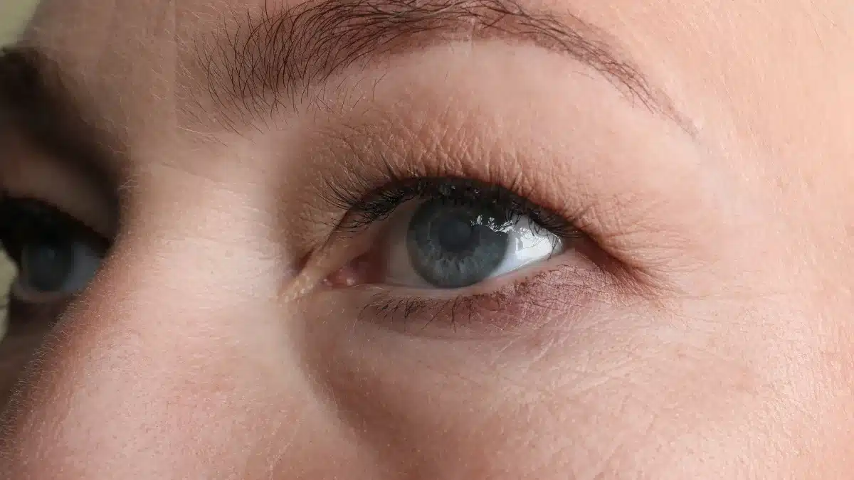 congenital cataracts