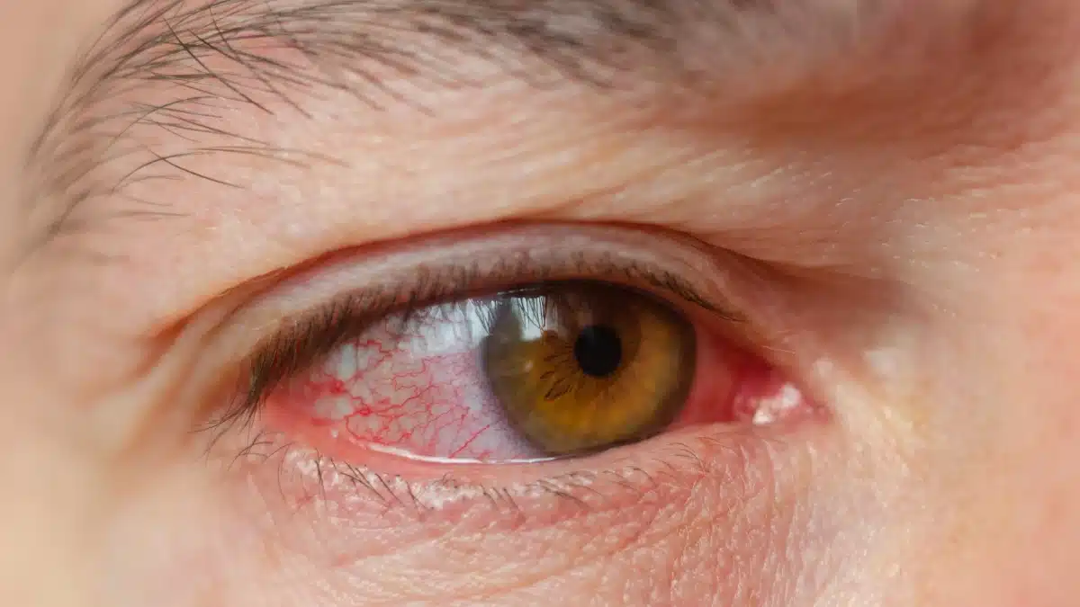 Glaucoma Red Eye