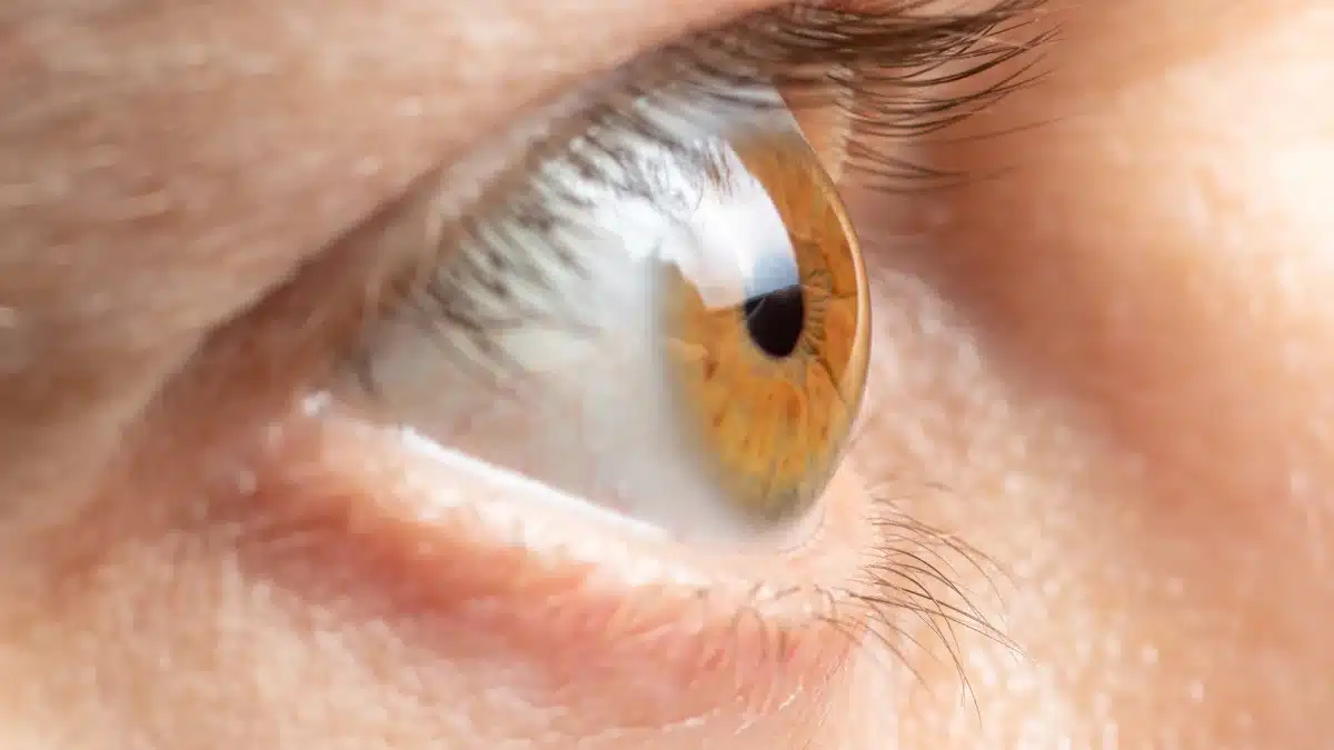 Ocular Hypertension vs Are They The Same?