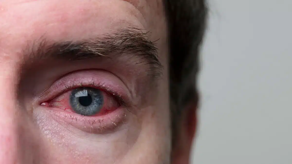 Dry Eye Allergy Causes, Symptoms, and More