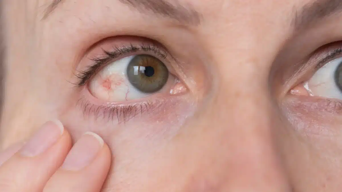 Vitamins to Reduce Eye Pressure A Comprehensive Guide